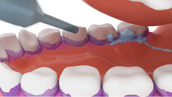 ВАП: Вентилятор-ассоциированная пневмония Развитие и профилактика 